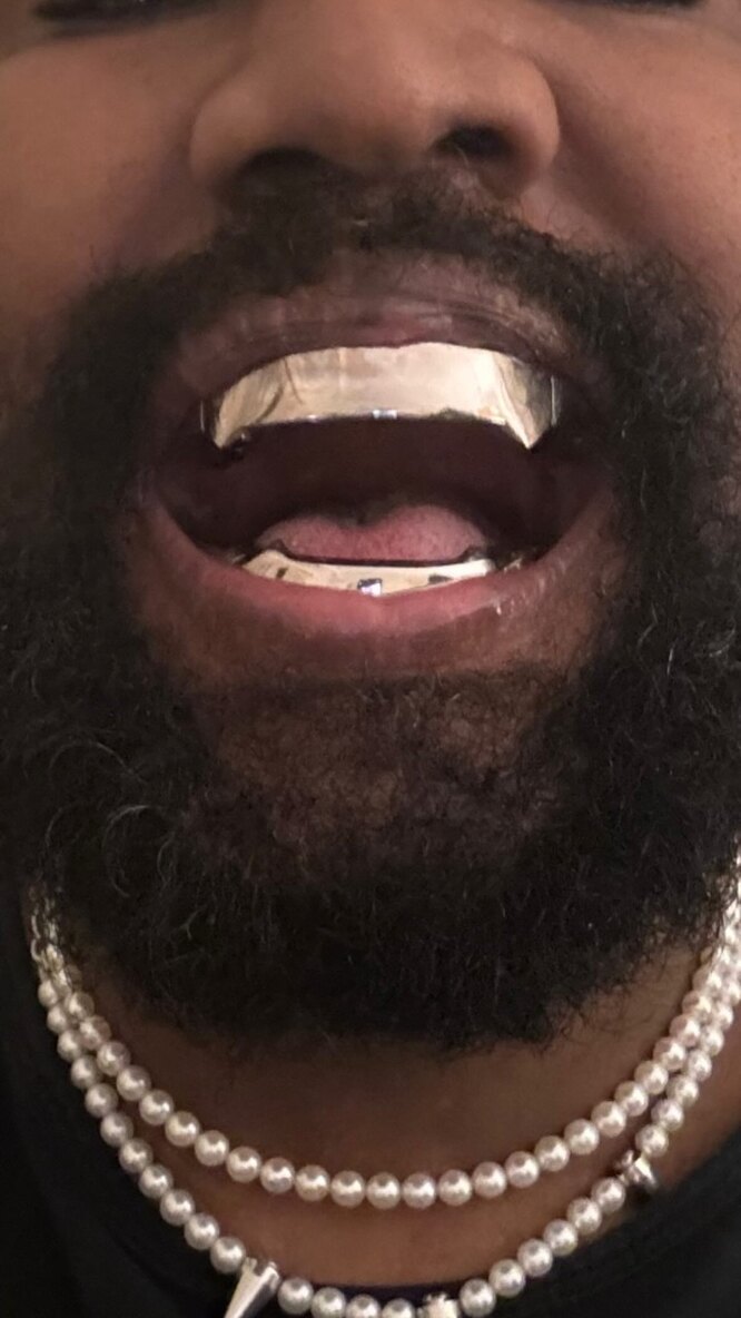Kanye west до и после пластики. Kanye west teeth. канье вест grillz. канье уэст заменил зубы титановым протезом. канье уэст заменил зубы титановым протезом.