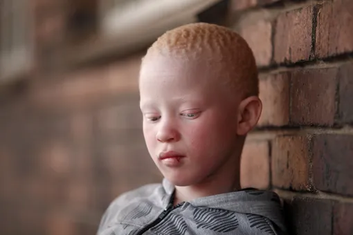 ООН: количество нападений на людей с альбинизмом с начала пандемии выросло во всем мире