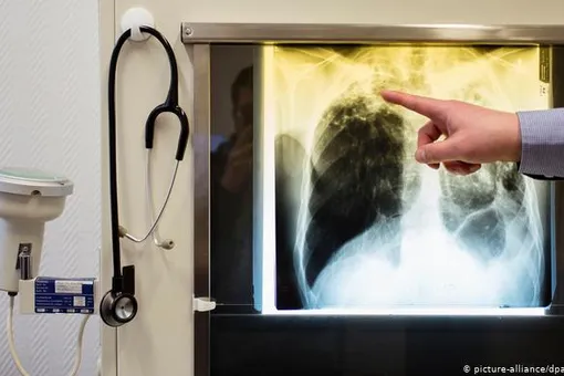В Германии 109 человек заразились туберкулезом в одной школе
