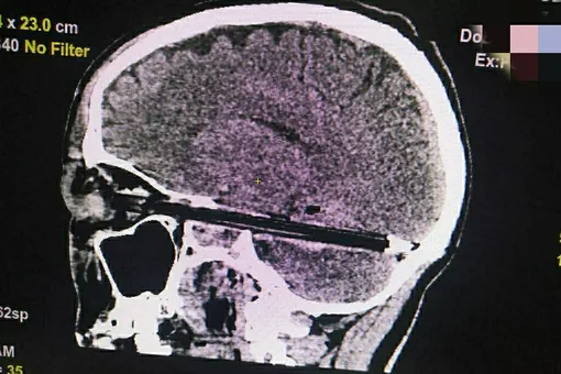 Умер 37-летний мужчина, из головы которого ростовские врачи достали шариковую ручку. Она вошла в мозг через глаз и не повредила сосуды
