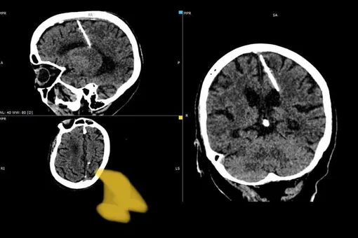 Врачи нашли иглу в мозгу 80-летней жительницы Сахалина. Родители ее воткнули, чтобы умертвить ребенка еще в младенчестве