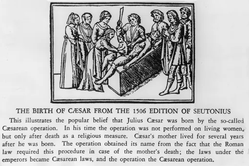 Гравюра на дереве, изображающая первую операцию кесарева сечения, проведенную при рождении Юлия Цезаря