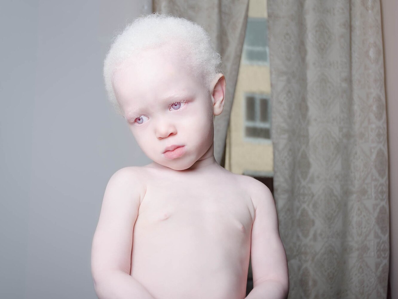 Генетические заболевания альбинизм